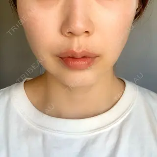 4日目の経過画像（1枚目）