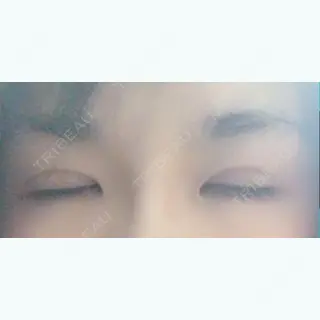 11日目の経過画像（2枚目）