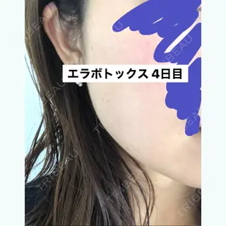 4日目の経過画像（2枚目）