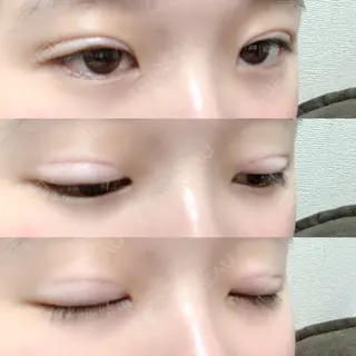 5日目の経過画像（2枚目）