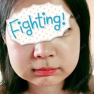 7日目の経過画像（1枚目）