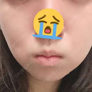 6日目の経過画像（2枚目）