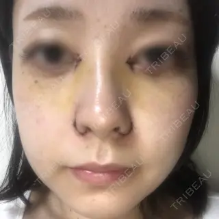 4日目の経過画像（1枚目）