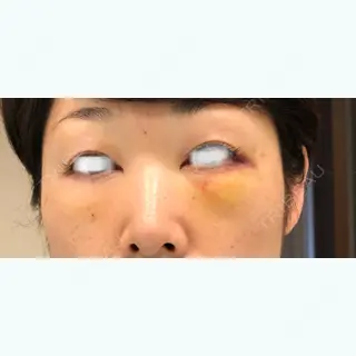 4日目の経過画像（1枚目）