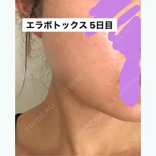 5日目の経過画像（2枚目）