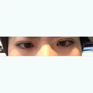 1日目の経過画像（2枚目）