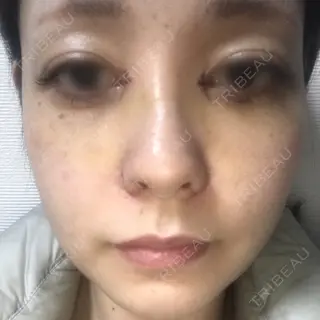 6日目の経過画像（1枚目）