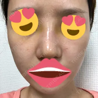 3日目の経過画像（1枚目）