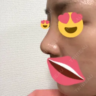 3日目の経過画像（2枚目）