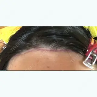 60日目の経過画像（3枚目）