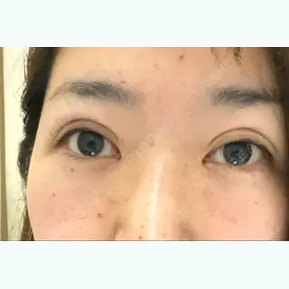 0日目の経過画像（1枚目）