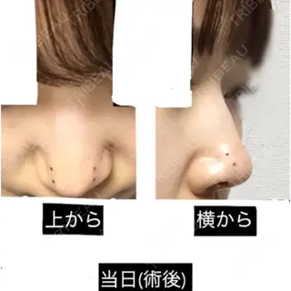 0日目の経過画像（2枚目）