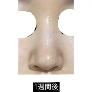 7日目の経過画像（1枚目）