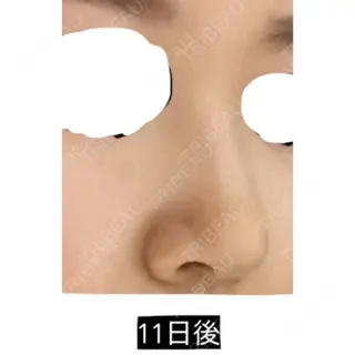 11日目の経過画像（2枚目）