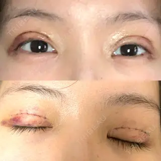 6日目の経過画像（1枚目）