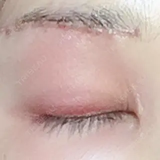 2日目の経過画像（2枚目）