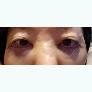 0日目の経過画像（1枚目）