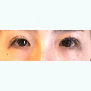 14日目の経過画像（1枚目）