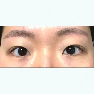 60日目の経過画像（1枚目）
