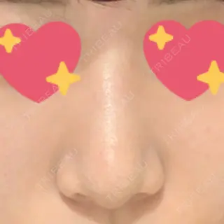 8日目の経過画像（1枚目）