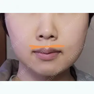 5日目の経過画像（1枚目）