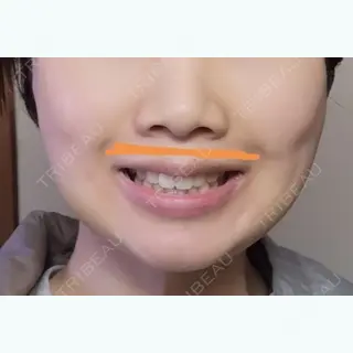 5日目の経過画像（2枚目）