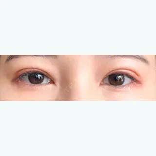 35日目の経過画像（1枚目）