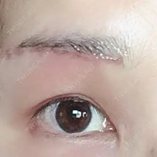 3日目の経過画像（1枚目）