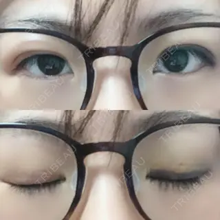 4日目の経過画像（1枚目）