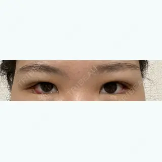 9日目の経過画像（1枚目）