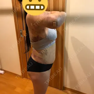 4日目の経過画像（2枚目）