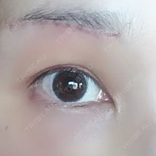 4日目の経過画像（1枚目）