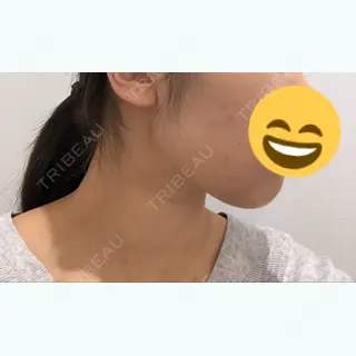 29日目の経過画像（3枚目）