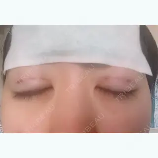 1日目の経過画像（2枚目）