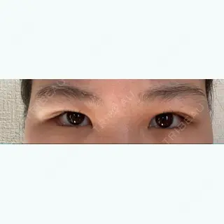 17日目の経過画像（1枚目）
