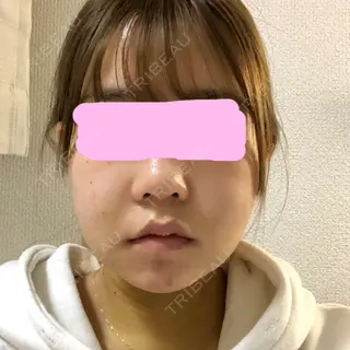 3日目の経過画像（1枚目）