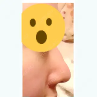 5日目の経過画像（1枚目）