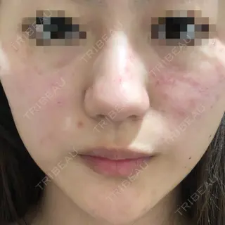 0日目の経過画像（1枚目）