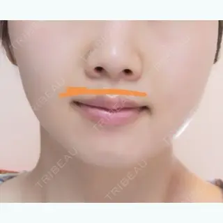 11日目の経過画像（1枚目）