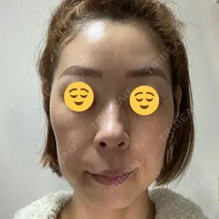 20日目の経過画像（1枚目）
