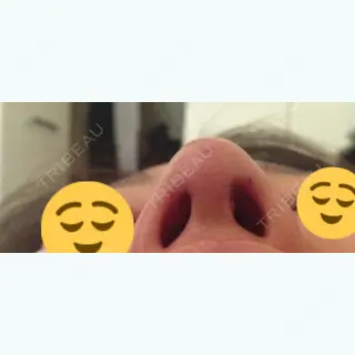 5日目の経過画像（2枚目）