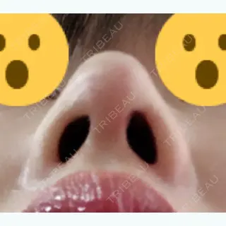 48日目の経過画像（2枚目）