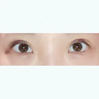4日目の経過画像（1枚目）