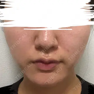 91日目の経過画像（1枚目）