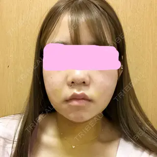 4日目の経過画像（1枚目）