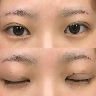 20日目の経過画像（1枚目）