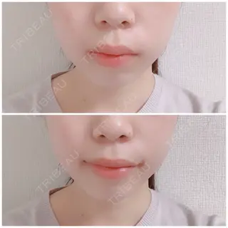 0日目の経過画像（1枚目）