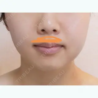 12日目の経過画像（1枚目）