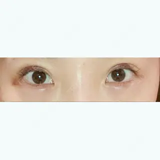 5日目の経過画像（1枚目）