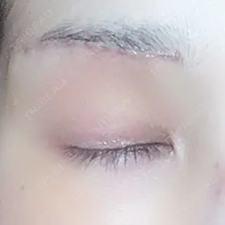 6日目の経過画像（2枚目）